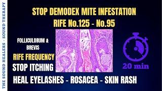 DEMODEX  Stop Itching  Mite Infestation  Heal Eyelashes  Dermatitis  Skin Rash  Sound Therapy