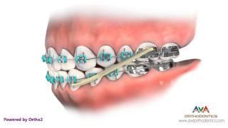 Orthodontics Treatment for Underbite or Crossbite - Rubber Bands