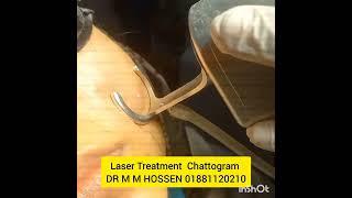 Fractional Co2 laser treatment now in Chattogram#dark spot#sunburn #skin brightening 01881120210