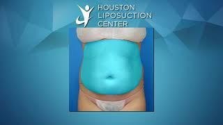 Liposuction for Women ~ Liposuction Before & After ~ Abdomen Liposuction