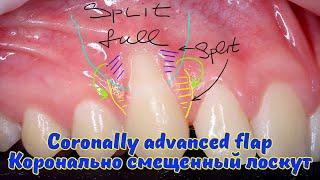 Лечение рецессии десны методом КСЛ // Coronally advanced flap for single gum recession treatment