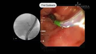 ERCP Procedure Video | Best Gastroenterologist in Bangalore - Dr Dinesh Kini | Sakra World Hospital