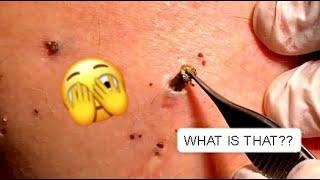 DO YOU BELIEVE THIS !!!  YOU HAVE NEVER SEEN THIS BEFORE  #relaxing #blackheads