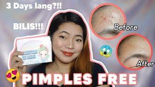 PIMPLES TREATMENT FOR 3 DAYS ONLY? | Mareng Vic