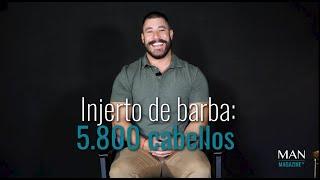 INJERTO DE BARBA FUE Neotech 3D® - 5800 Cabellos injertados