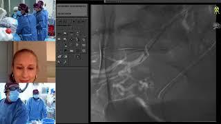 Transradial Uterine Artery Embolization for Symptomatic Uterine Fibroids (UFE)