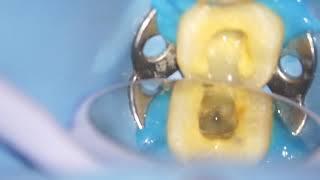 Root canal treatment on a cracked tooth