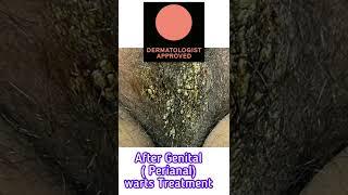 Perianal warts Treatment | Genital warts Treatment |Dr Ashima Goel #shorts #drashimagoel