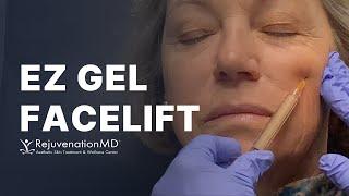 EZ Gel Facelift: Instant Volume, Natural Rejuvenation!