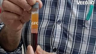 PRP(PLATELET RICH PLASMA)/ GFC (GROWTH FACTOR CONCENTRATE)