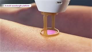 Laser hair removal - GentleMax Pro Plus (3D medical device animation)