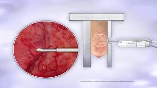 Brevera Breast Biopsy System - Animation