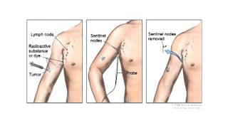 Surgical Management of Malignant Melanoma