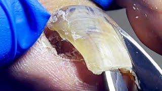 The Inside Of The Toenail Is Deteriorating, Be Careful To Separate It【Pedicure Master Lin Jun】