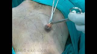 Huge GynecomastiaSurgery by Dr Ashwani Kumar at BLINIQ