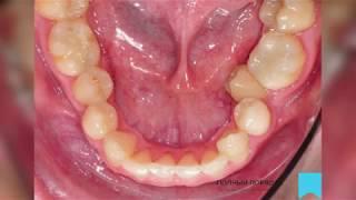 Постановка зуба в зубной ряд - ракурс с окклюзии. Видео 2