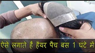 Hair Patch for Men in Delhi | Hair Patch Price | Hair Patch Near Me by Ritu Hair Wigs 9990115900