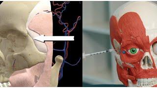 Use these Botox injection points for Crows Feet. Botox Anatomy Training