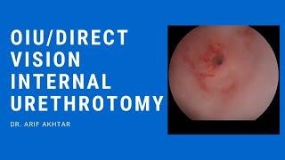 Direct Vision Internal Urethrotomy - Optical Internal Urethrotomy