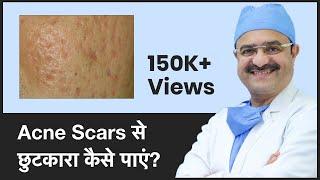 Acne Scars: Causes & How To Get Rid Of Acne Scars (Acne Scars से छुटकारा कैसे पाएं)| (In HINDI)