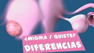 Diferencia entre quiste y mioma