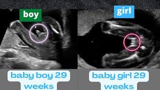 Ultrasound Showing a Boy and a Girl Baby Both at 29 Weeks