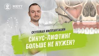 Скуловая имплантация без синус-лифтинга