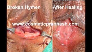 Virginity Tightening Hymen Repair Layered Hymenoplasty Surgery Delhi NCR India.