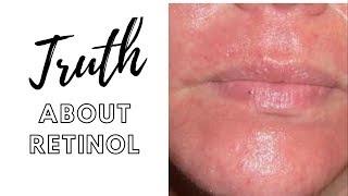 THE TRUTH ABOUT RETINOL WHAT YOUTUBE IS NOT TELLING YOU