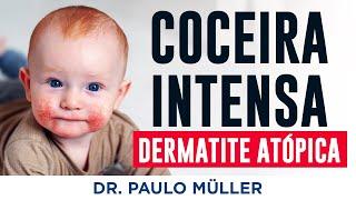 Coceira Crônica - Tudo Sobre Dermatite Atópica - Dr. Paulo Muller Dermatologista.