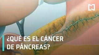 ¿Qué es el Cáncer de Páncreas?; avances en el Cáncer de Páncreas - A las Tres