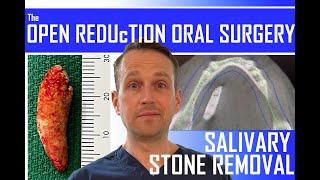 BIGGEST SALIVARY STONE I'VE EVER SEEN! SIALOLITH REMOVAL | ORAL SURGERY