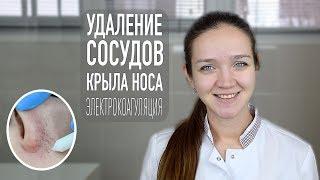 Удаление сосудистой сетки на лице | косметология Самара