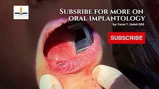 Mucocele Removal