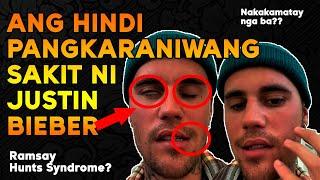 Ano Nga Ba Ang Ramsay Hunt Syndrome? Nakakamatay Ba ito? | Kaalamazing