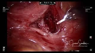 Robotic Management of Ectopic Ureter: Unedited