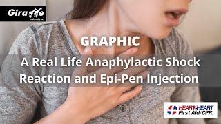 A Real Anaphylactic Shock Reaction and Epi-Pen Injection
