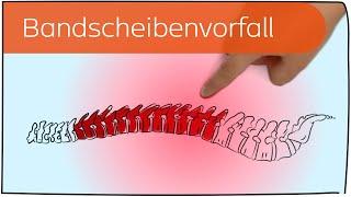 Bandscheibenvorfall in 3 Minuten erklärt