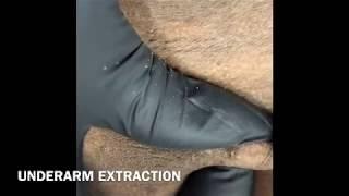 Post underarm wax extraction
