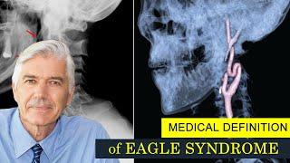 EAGLE SYNDROME. Medical Definition of EAGLE SYNDROME