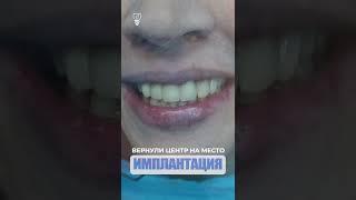 Новая моделировка зубов. New teeth modeling. Implantation.