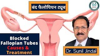 Blocked Fallopian Tubes