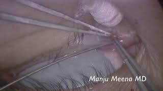 Juxtapunctal Nevus Excision with Masterka Intubation - Dr Manju Meena