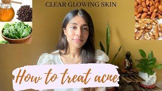 How to treat acne at home | skincare |Anvaya Sharma  #preventacne