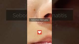 How to treat Seborrheic Dermatitis! #shorts