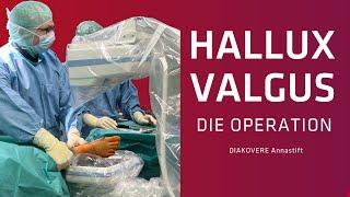 Operation eines Hallux Valgus: Minimalinvasiver Eingriff im DIAKOVERE Annastift Hannover