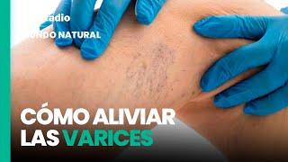 Mundo Natural: Cómo aliviar las varices