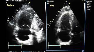 Pulmonary embolism