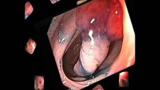 Gastrointestinal Endoscopy