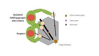 Learning Laparoscopic Sigmoid Colectomy (High Anterior Resection)